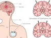 Нейростимуляція: як технології змінюють лікування хвороб мозку