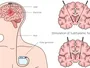 Нейростимуляція: як технології змінюють лікування хвороб мозку